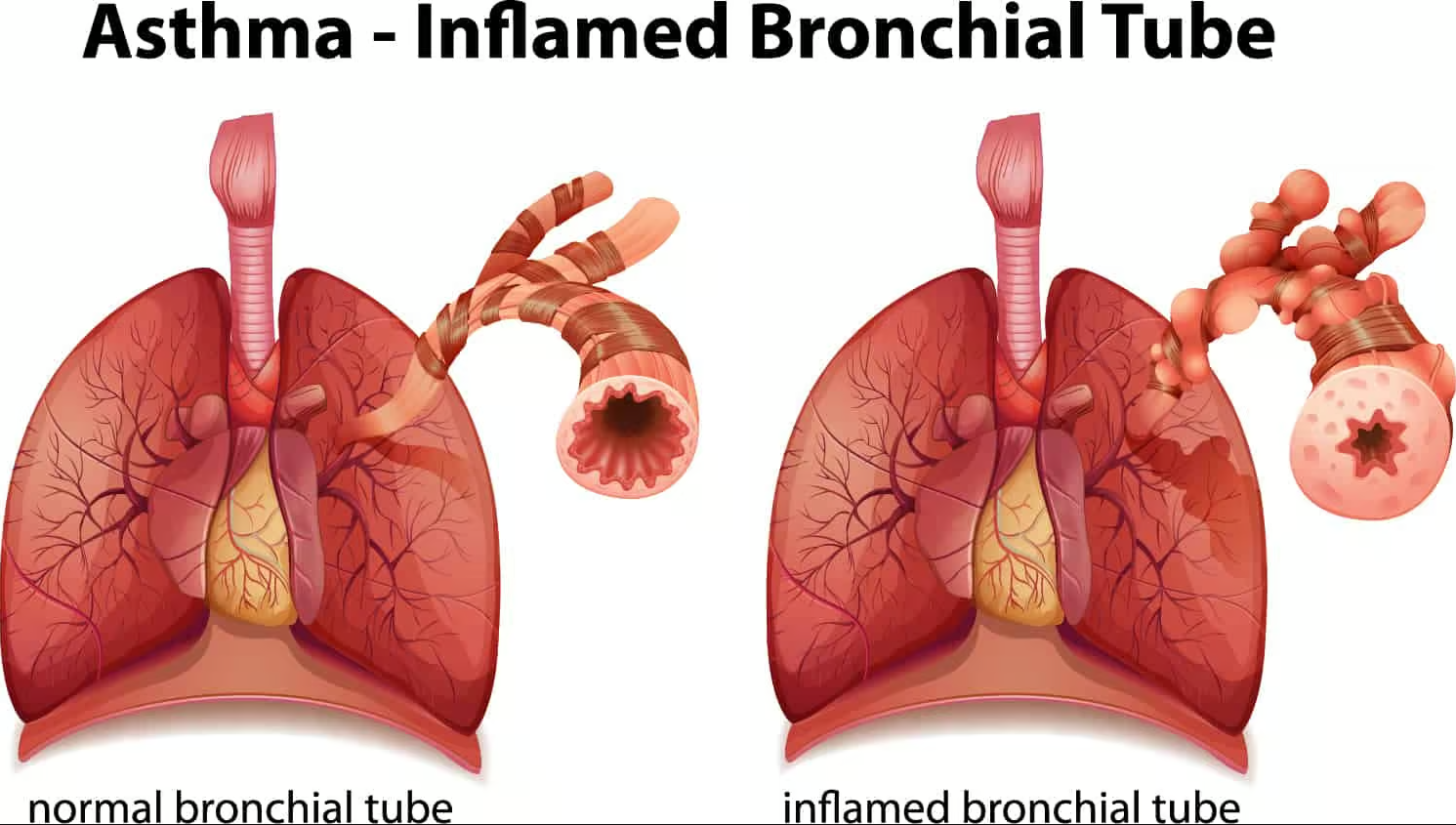 asthma bronchial tube