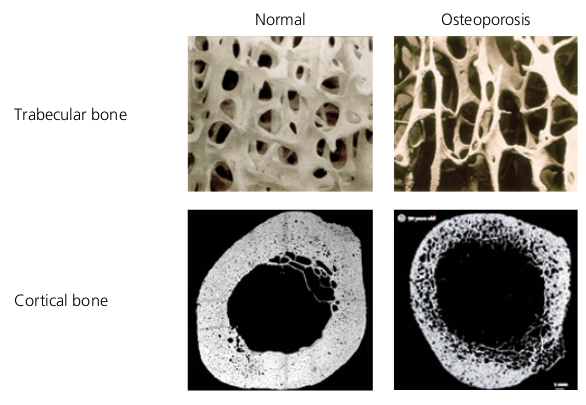trabecular