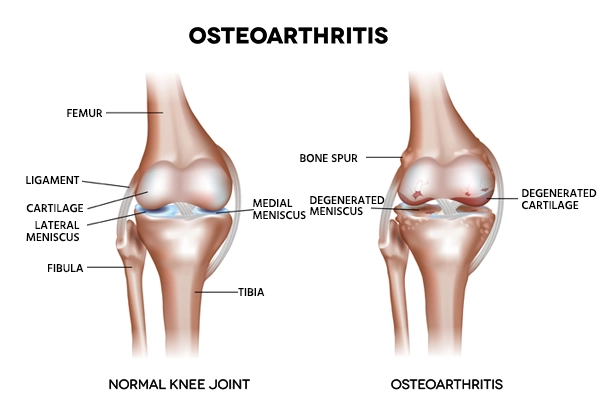 Расшифровка остеоартрита: Современный взгляд на здоровье суставов и прогрессирование болезни